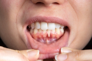 woman pulling down lip to show off inside mouth and gums