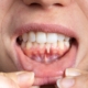 woman pulling down lip to show off inside mouth and gums