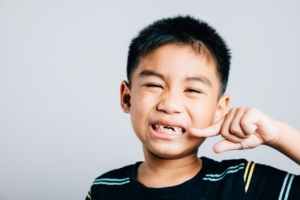 little boy showing knocked out front teeth in smile