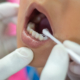 close up of pediatric dentist painting on fluoride varnish to child's teeth