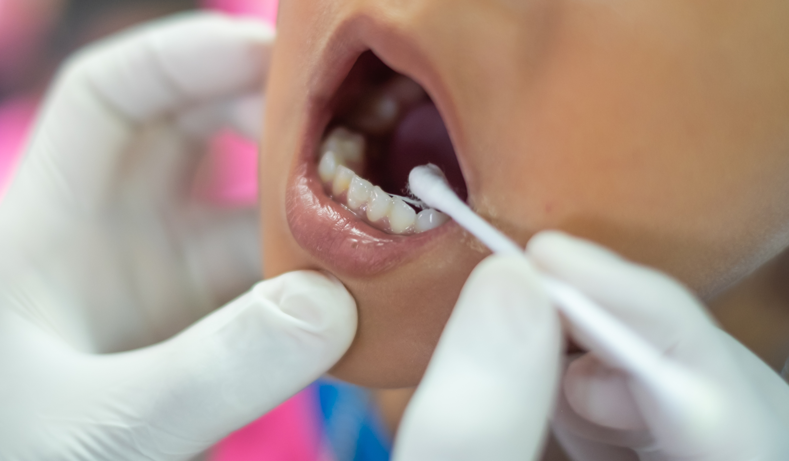 close up of pediatric dentist painting on fluoride varnish to child's teeth